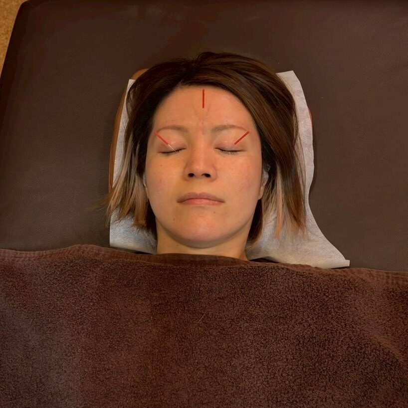 「花粉症の鍼治療を受ける女性。眉間・目の周りに鍼が刺入されている様子」